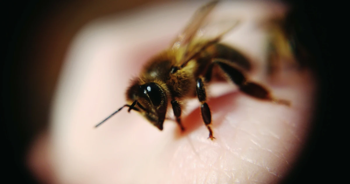 Understanding Bee Stings: Symptoms, Duration, and When to Seek Help