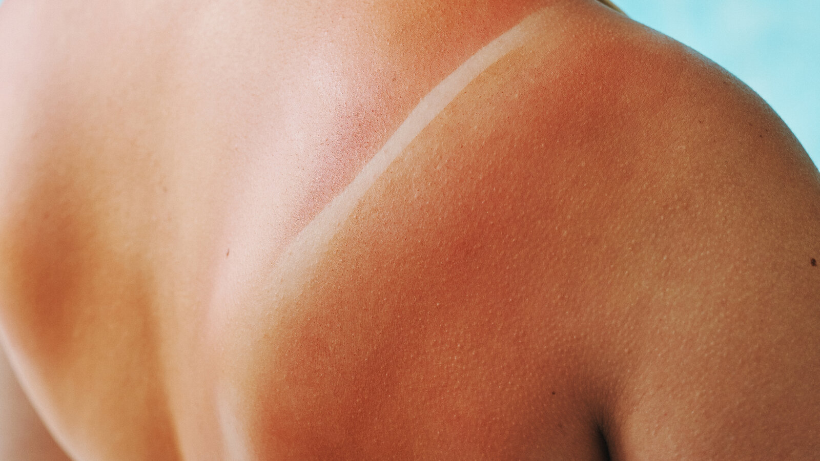 How To Treat Sunburns: Effective Remedies and Prevention Tips