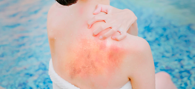 Beat the Itch: How to Handle Chlorine Rash This Summer