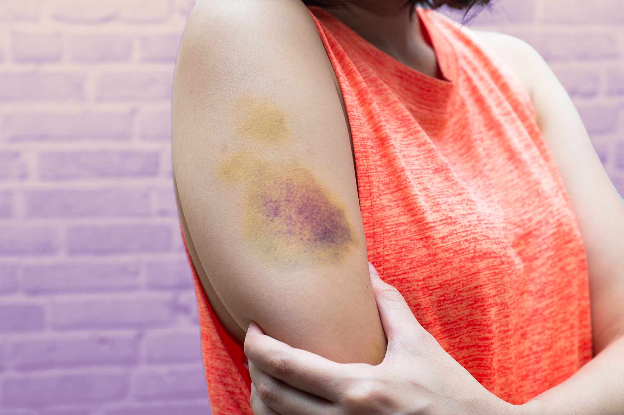 What Are Bruises? Causes, Healing, and Remedies