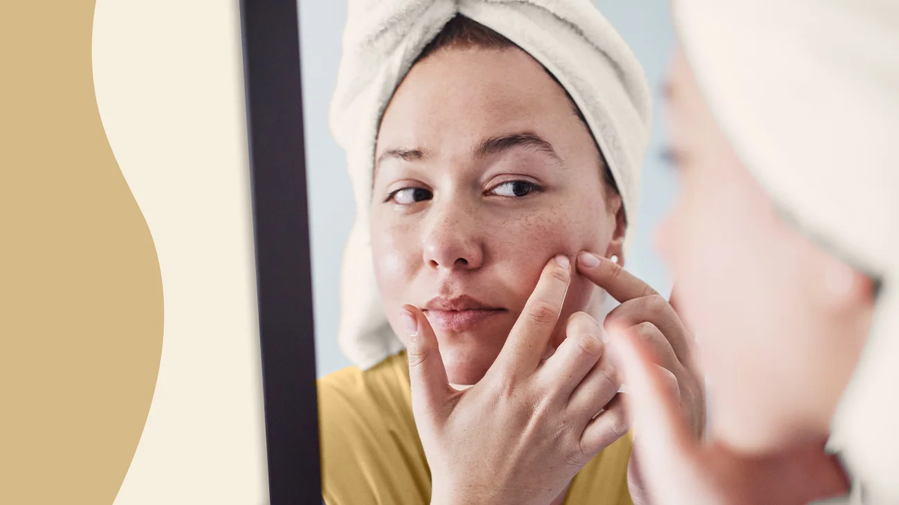 Acne Beyond Adolescence: Understanding and Managing Adult Breakouts