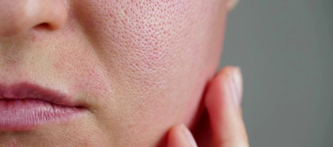 How To Minimize Pores And Their Appearances? Here's What Experts Say