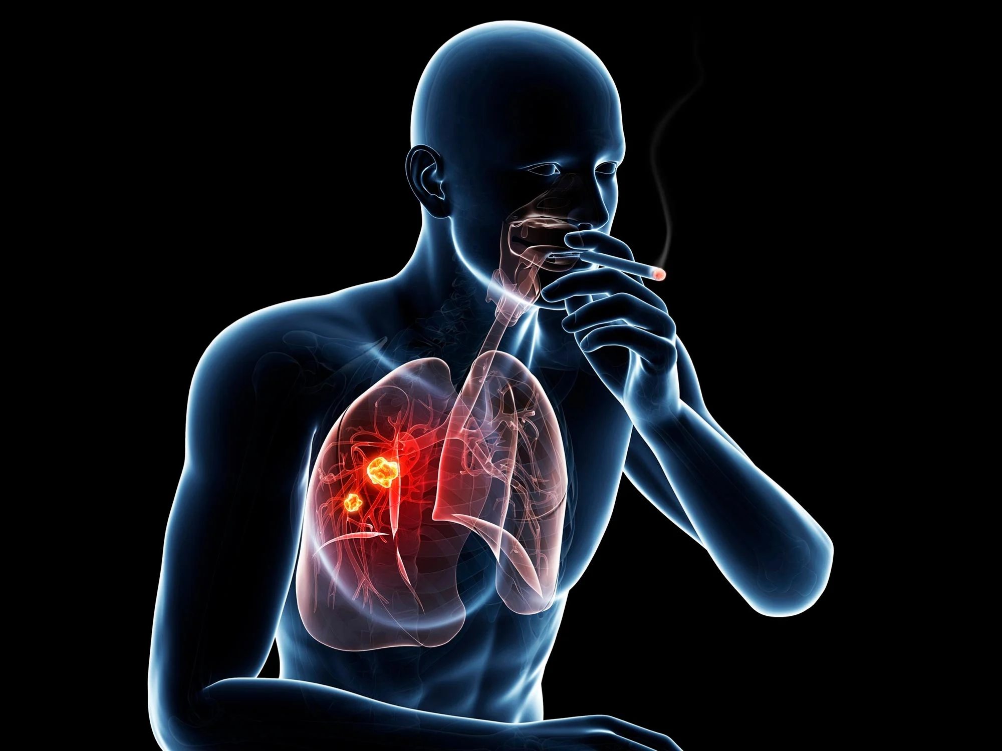 What Causes Lung Cancer? Smoking Is Not The Only Reason.